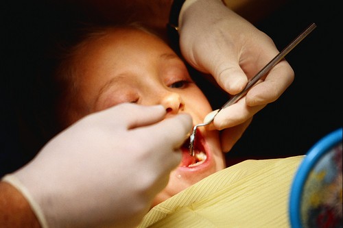 Серебрение детских зубов
